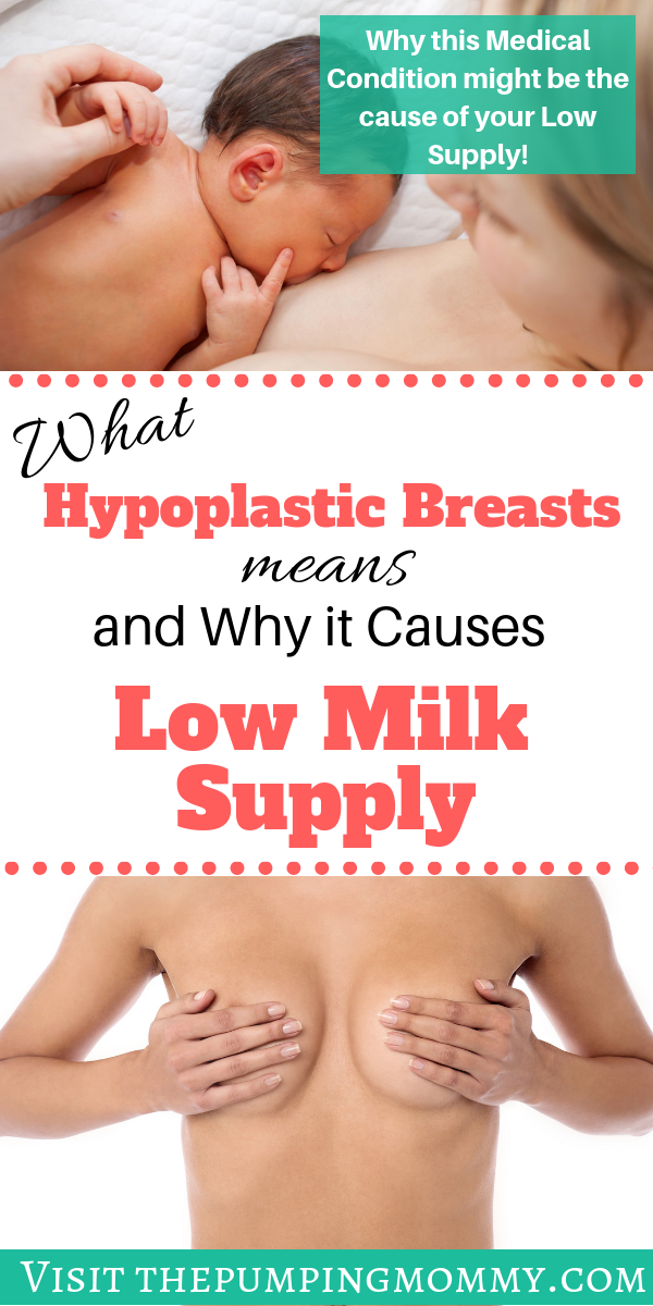 Hypoplastic Breasts and Breastfeeding